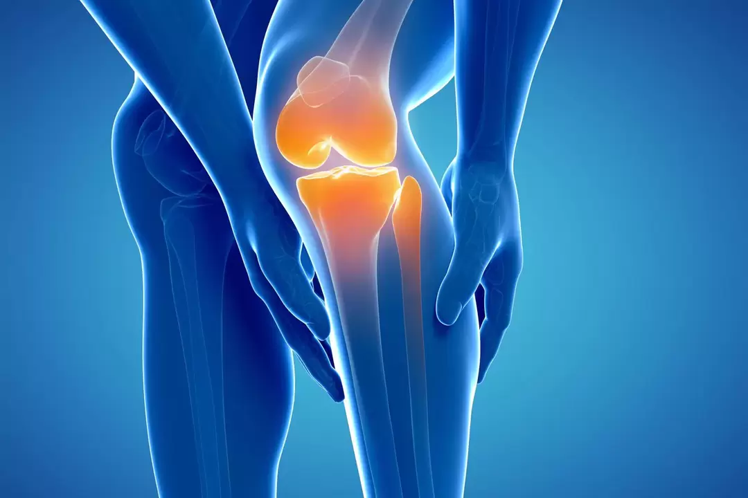 Artroza kolenskog zgloba (gonartroza, deformirajući osteoartritis)