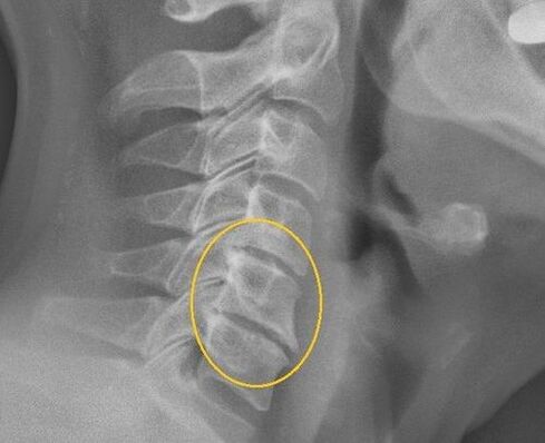 Osteohondroza grlića kralježnice na x -ray
