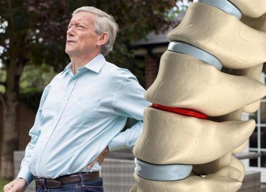 Osteohondroza zahvaća intervertebralne diskove i uzrokuje bol u leđima