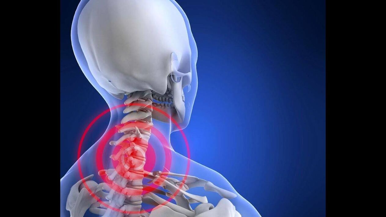 Osteohondroza vratne kičme